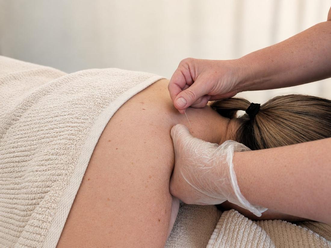 Dry needling — hands-on technique